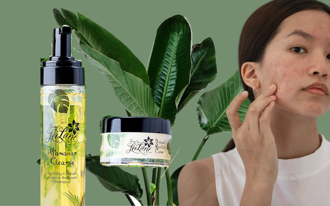 Battling Acne: Understanding, Causes, and Skincare Routine - Sweet LeiLani